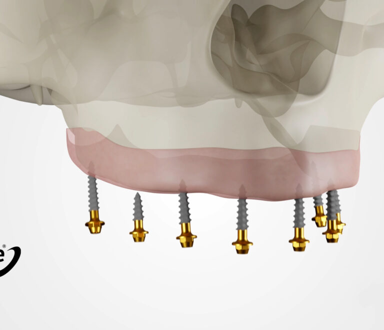 Compressive Multi Unit Implant