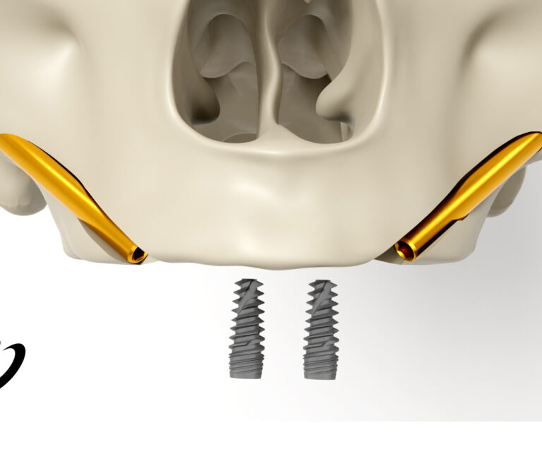 Spiral Implant