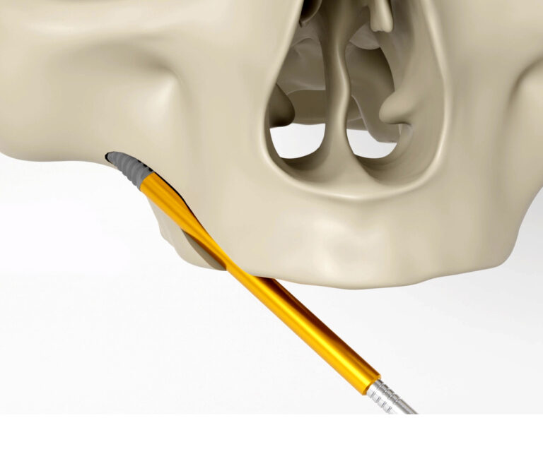 Zygoma Implant